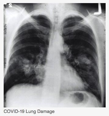 COVID-Lung-Damage-.png